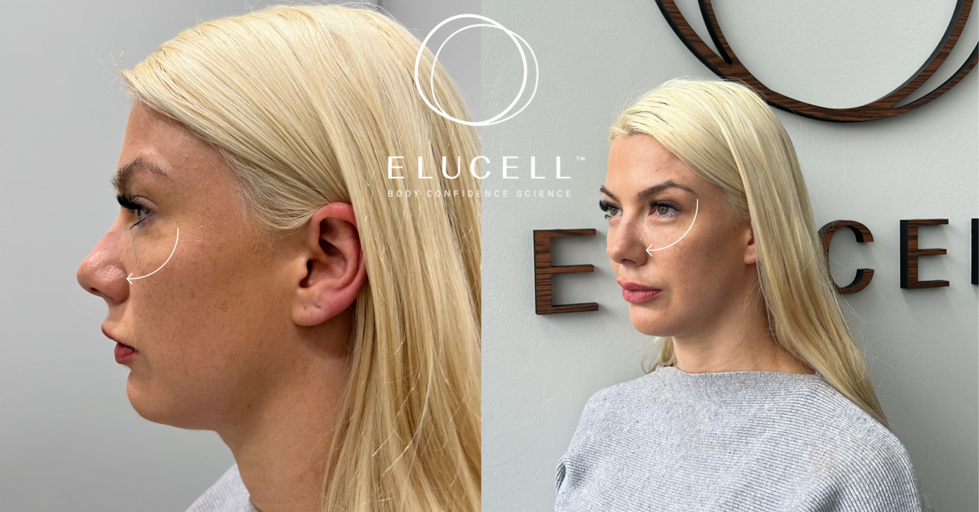 About PDO Thread Lifts Melbourne Elucell