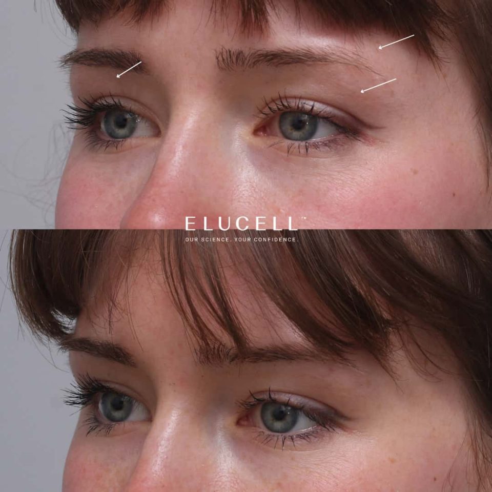 Before and After Brow Thread Lift Melbourne