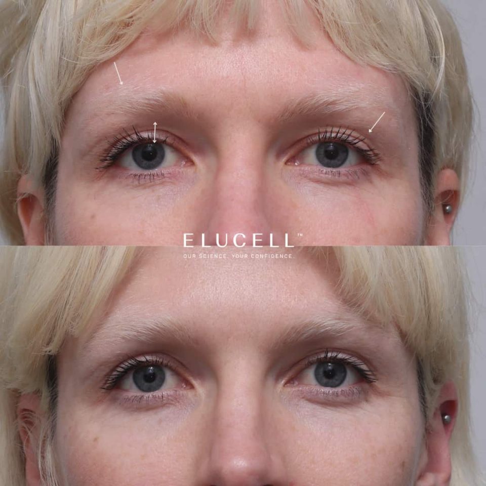 Before and After Results Brow Thread Lift