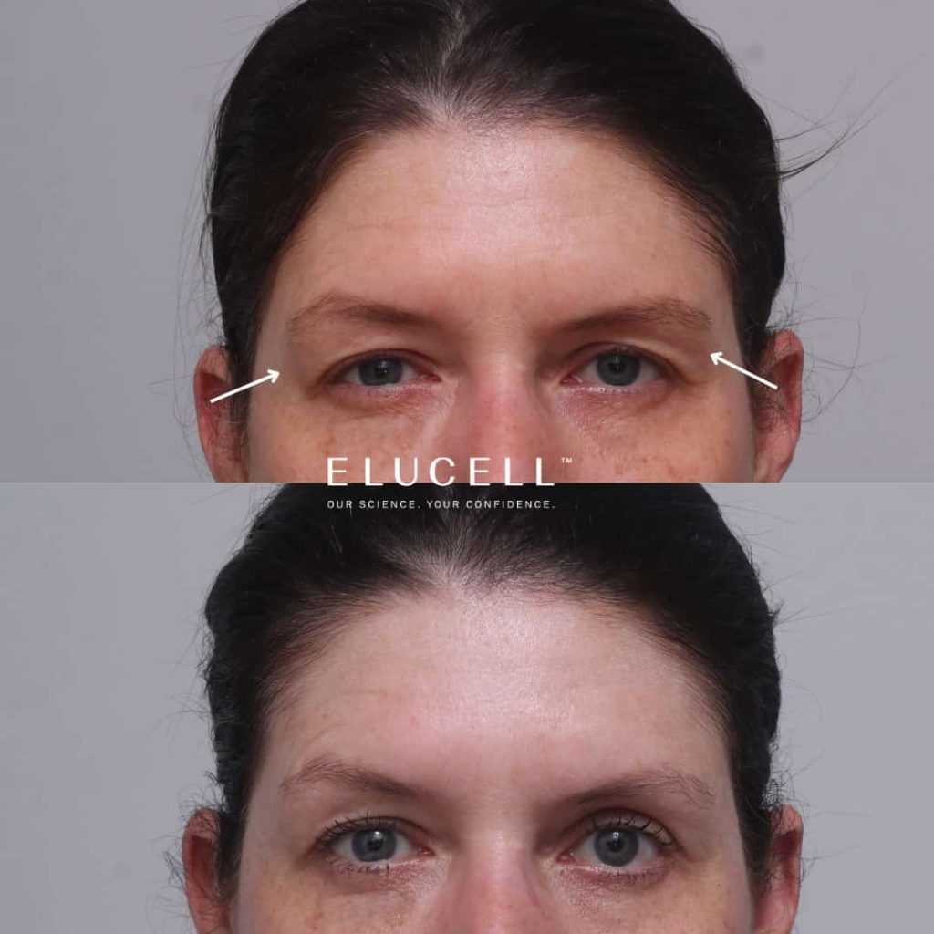 Brow Thread Lift Melbourne Elucell
